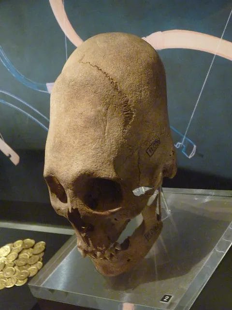 Fifth-century skull from Mozs, Hungary, showing deliberate cranial deformation typical of Hunnic-period burials.