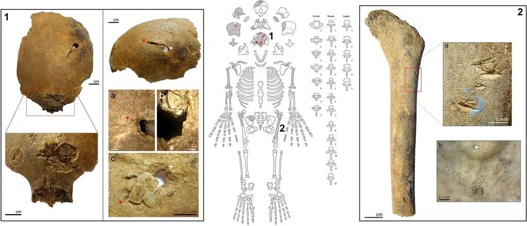 Schematic and close-ups of lesions on Jebel Sahaba skeleton JS-14, showing projectile impacts and blunt-force trauma; useful for discussing methods of identifying prehistoric violence.
