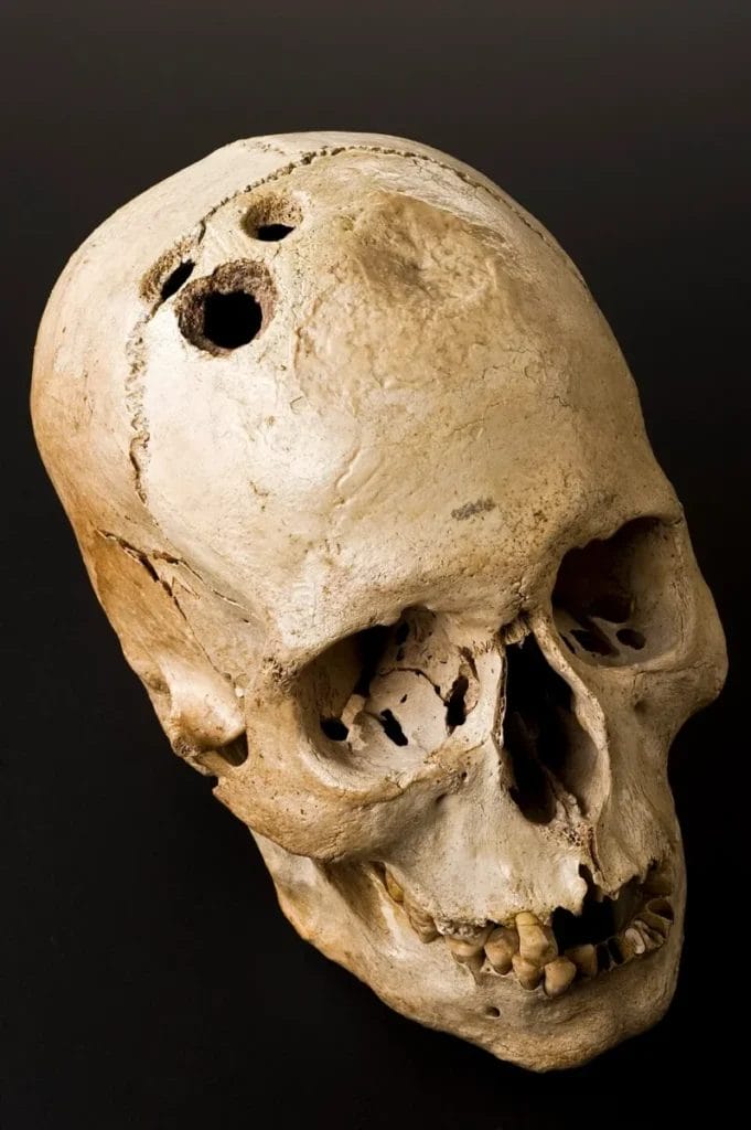 Bronze Age human skull showing four healed circular holes from ancient trepanation surgery