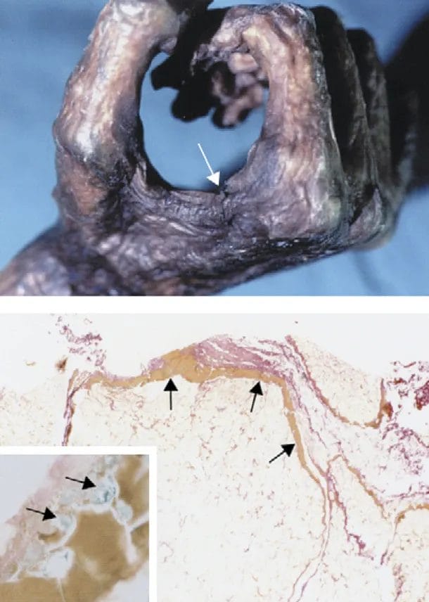 Ötzi death hand wound combat