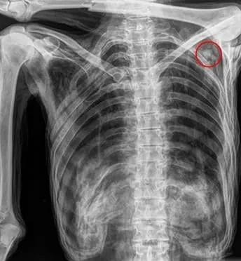 X-ray of Ötzi reveals the stone arrowhead